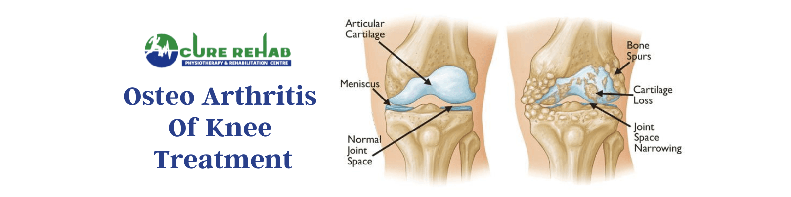 OA Knee at Cure Multispeciality Rehab