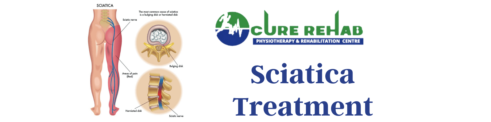 Sciatica at Cure Multispeciality Rehab