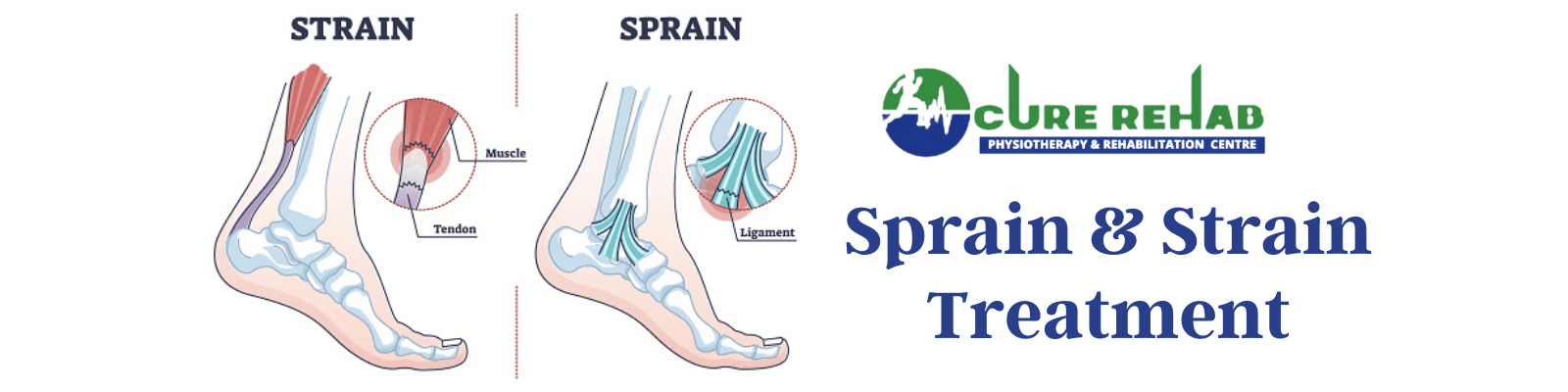 Sprain and Strain at Cure Multispeciality Rehab
