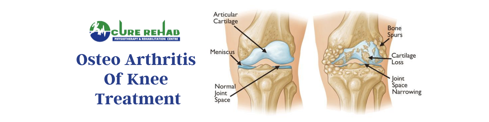 OA Knee