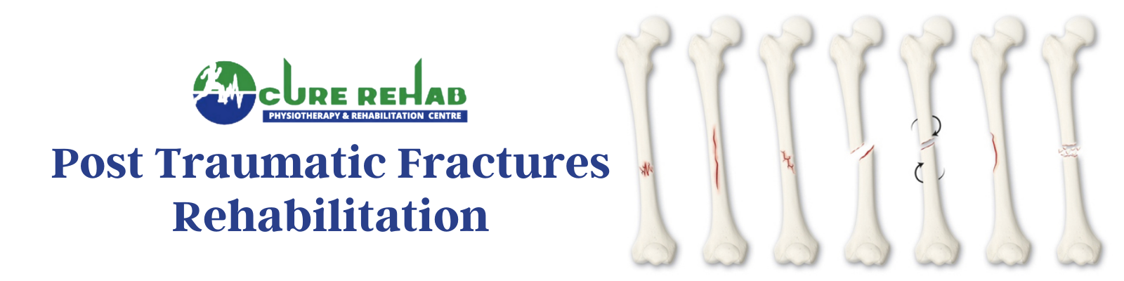 Post Traumatic Fractures Care