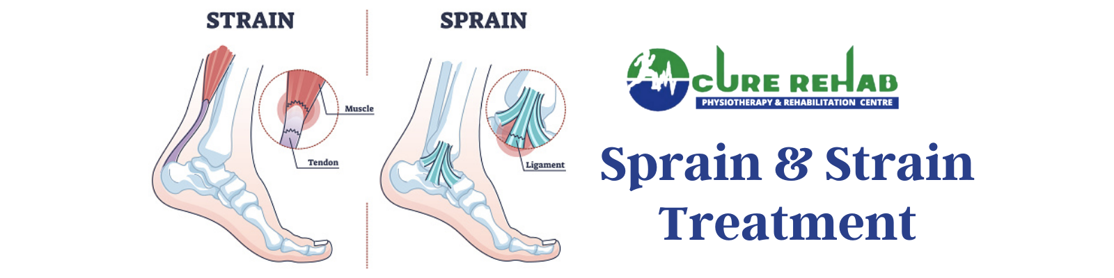 Sprain and Strain